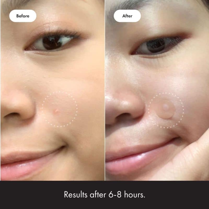 Hero Cosmetics Mighty Patch - Image 4